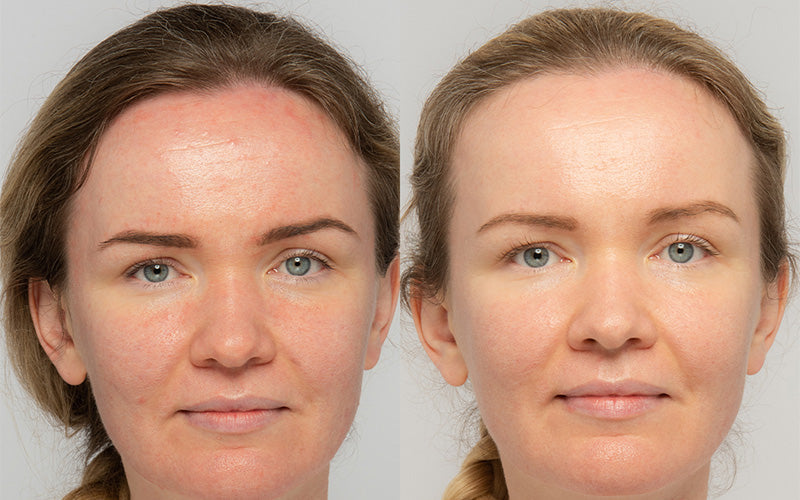 Real Skin, Real Results — Redness, Spots