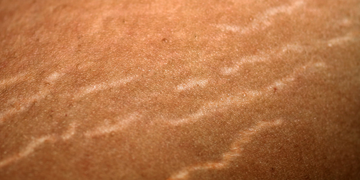 The Mystery of Stretch Marks